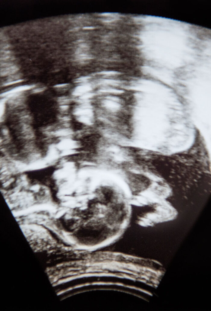 Udredning af gentagne graviditetstab (abortus habitualis)